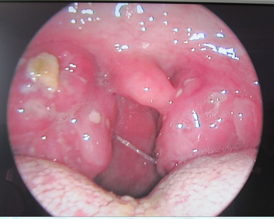 Mononucleosis cuando puedo volver a besar